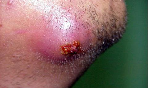 Carbuncle - Pictures , Symptoms , Causes, Treatment and