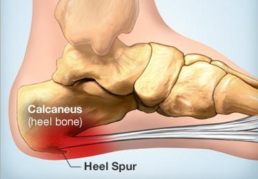 Heel Discomfort