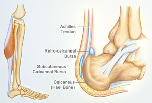 Heel Discomfort