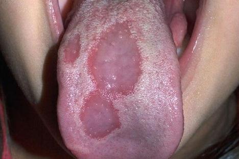 What are some remedies for a sore tongue?