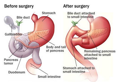 Whipple Procedure photo