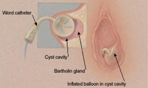 Bartholin Gland Cyst drainage