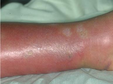 Erysipelas - Causes, Pictures, Treatment, Infection, Symptoms.