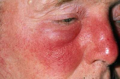 Erysipelas - Causes, Pictures, Treatment, Infection, Symptoms.