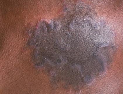 Erythema-Annulare-Centrifugum-image