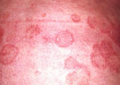 Erythema-Annulare-Centrifugum-photo