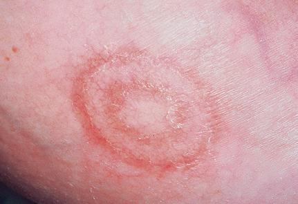 Erythema Annulare Centrifugum picture