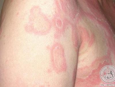 Erythema Annulare Centrifugum 1