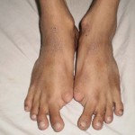 Fibrodysplasia Ossificans Progressiva - Pictures, Symptoms, Treatment