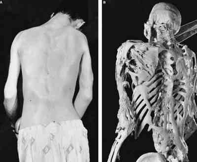 proteus syndrome skeleton