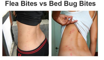 Flea Bites - Humans, Pictures