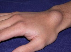 ganglion cyst at wrist of upper arm