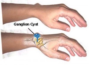 ganglion cyst at wrist region