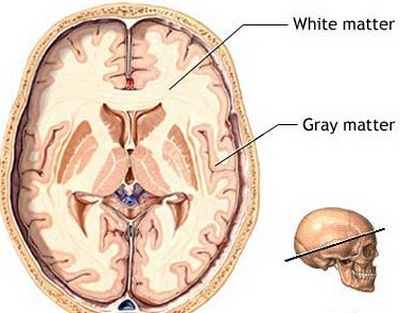 progressive multifocal leucoencephalopathy