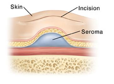 anatomy of seroma