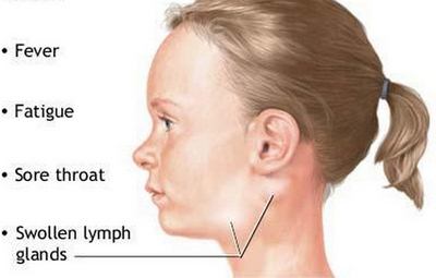 Glandular Fever symptoms in adults, children