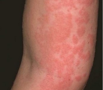Gluten Allergy rash pictures on hand in children, adults