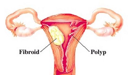 Polyps in Uterus and fibroids