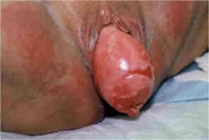 Prolapse Uterus Symptoms