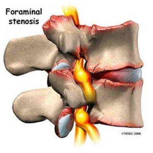 Foraminal Stenosis Symptoms