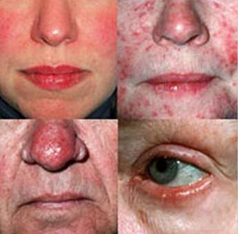 four forms of rosacea