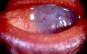 ocular pannus - exceesive pannus, corneal thinnning