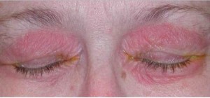 ocular rosacea pics