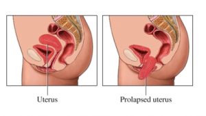 prolapsed uterus image