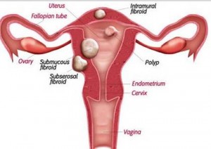 uterine polyps and fibroids