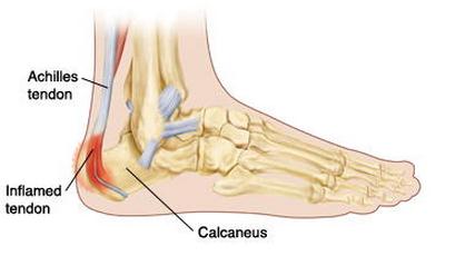 Calcaneal Apophysitis Image