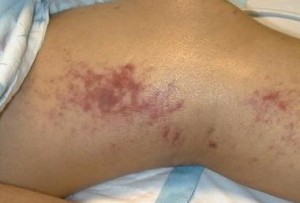 Images of Panniculitis