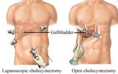Gallbladder removal Side effects