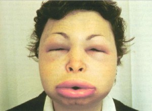 Angioedema picture