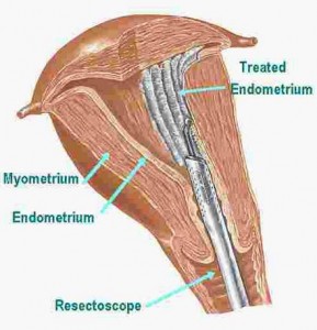 Endometrial Ablation procedure pics