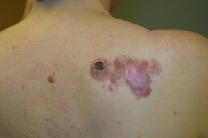 Advanced Dermatofibrosarcoma protuberans image