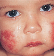 Allergic Contact Dermatitis on the face pics