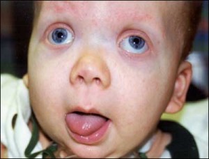 Beckwith Wiedemann Syndrome pictures
