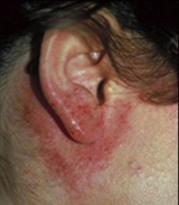 Pictures of Contact dermatitis on the ears