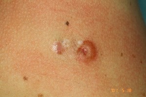 Dermatofibrosarcoma protuberans papule photo