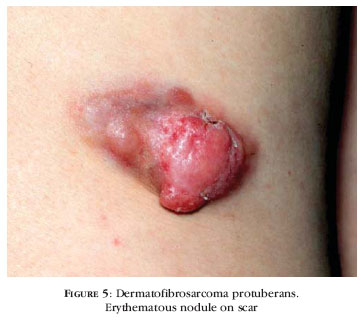Dermatofibrosarcoma protuberans picture