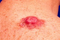Picture of Dermatofibrosarcoma protuberans tumor