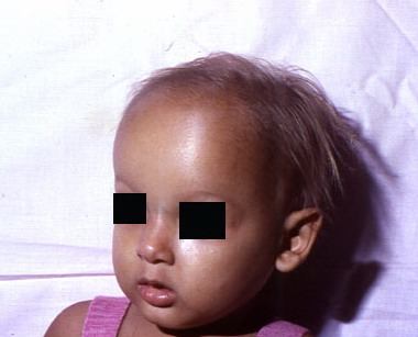 Frontal bossing Ectodermal dysplasia picture