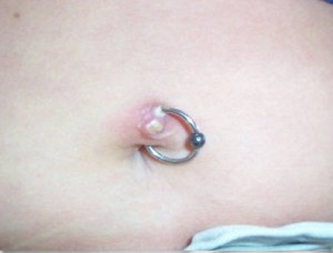 Pictures of Infected Belly Button Piercing