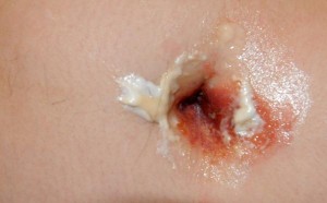 Infected Belly Button Piercing images