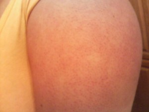 Keratosis Pilaris on the arms picture