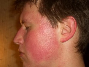 Image of Keratosis Pilaris on the face