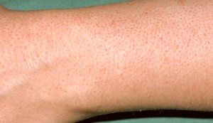 Keratosis Pilaris on the forearm image