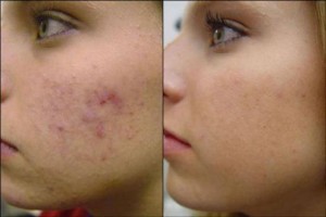 Post Inflammatory Hyperpigmentation After Laser treatment pics