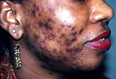 Post Inflammatory Hyperpigmentation â€