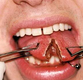 Tongue Piercing  pictures